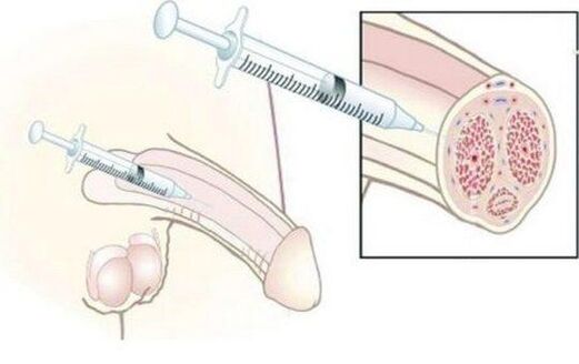 Hyaluronic Acid Injection Injection Injection