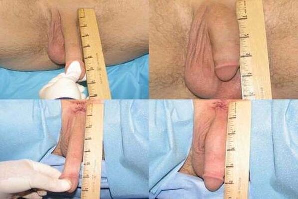 penis size after enlargement surgery