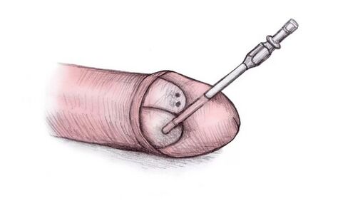 The head of the penis can be enlarged by injecting hyaluronic gel into it